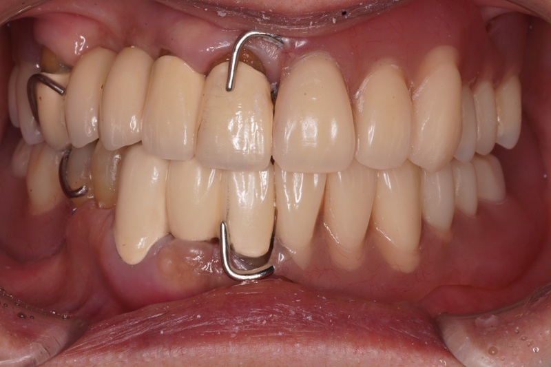 上下の部分床義歯による審美性・機能性の改善／上下の部分床義歯（金属床義歯）