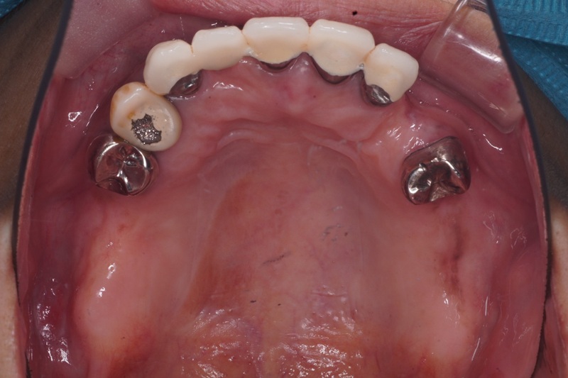 上顎部分床義歯（見た目と快適性を両立した設計）