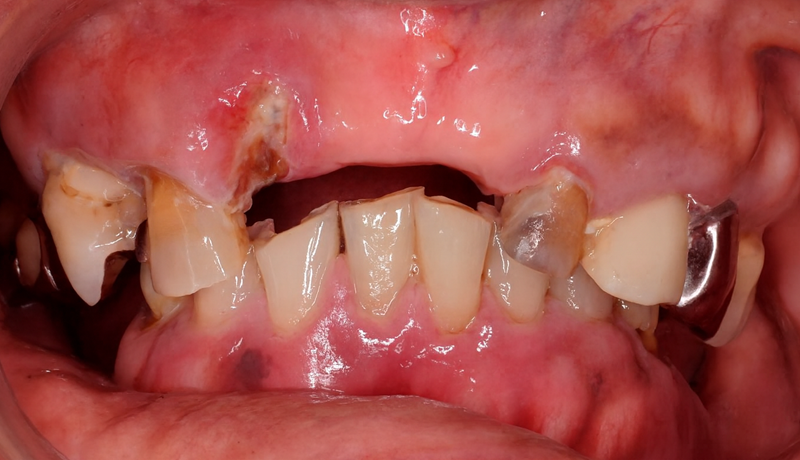 部分床義歯（部分入れ歯）