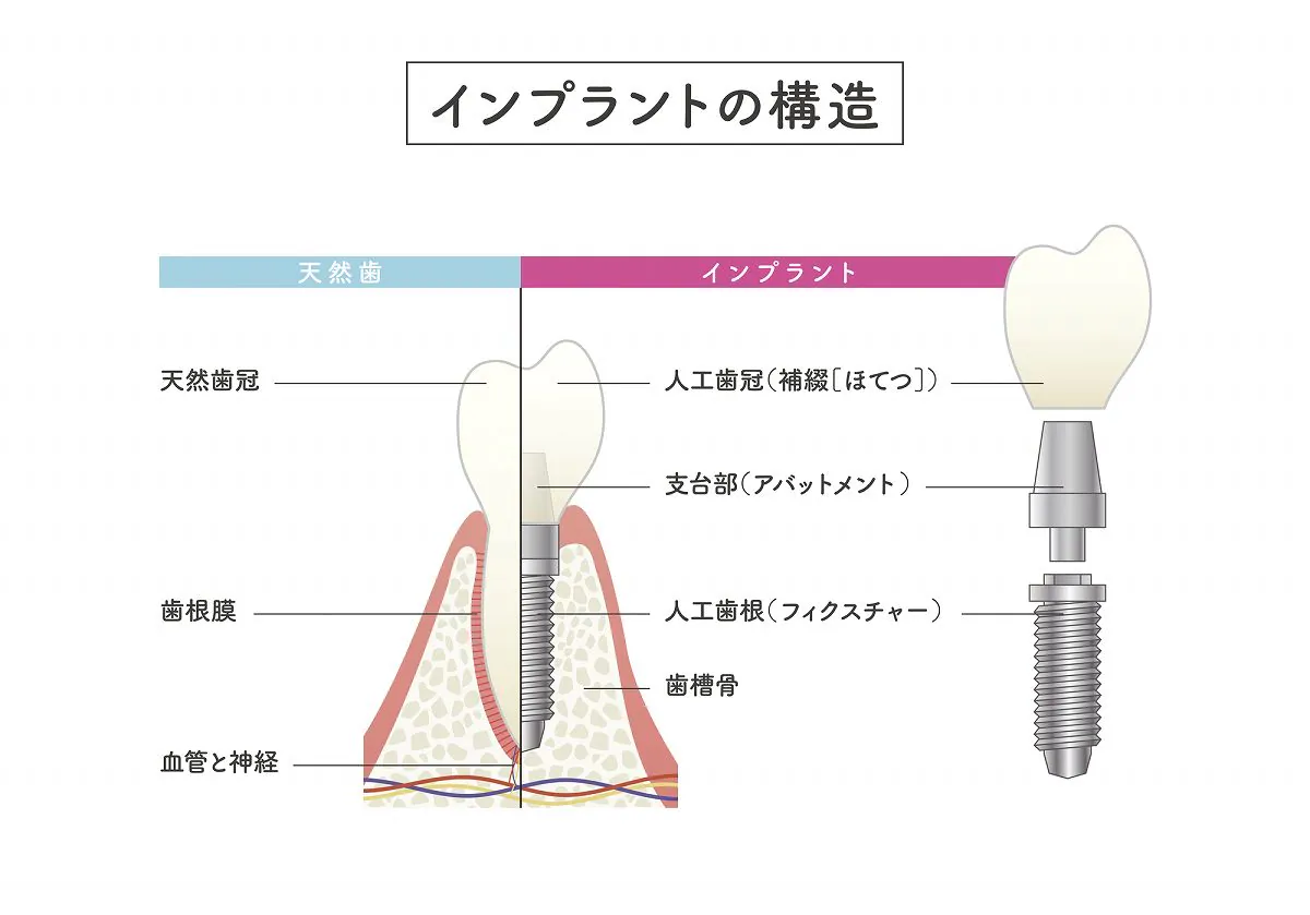 ご自分のように噛める！インプラントとは？