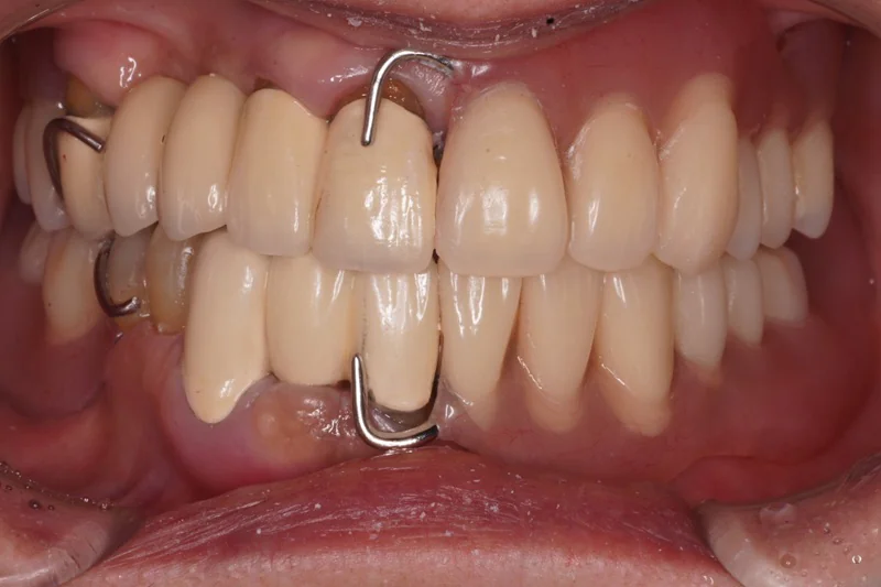 上下の部分床義歯による審美性・機能性の改善