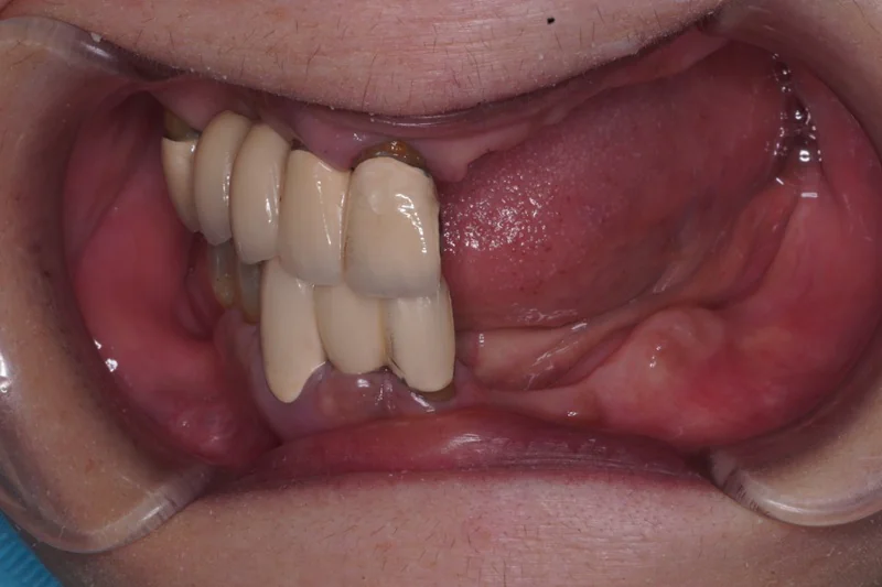 上下の部分床義歯による審美性・機能性の改善