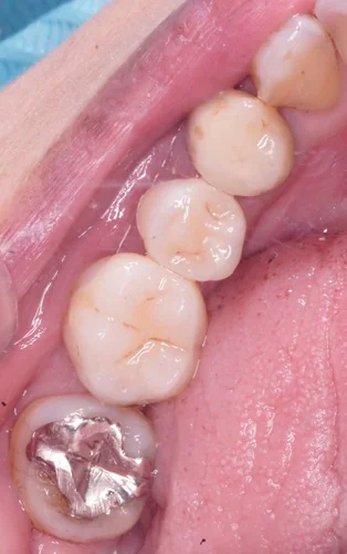 Emaxオンレーによる銀歯からの美しいセラミック修復
