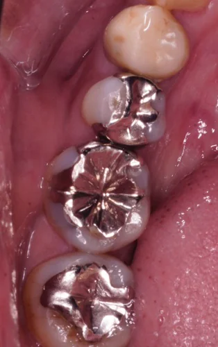 Emaxオンレーによる銀歯からの美しいセラミック修復