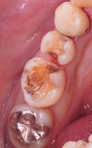 Emaxオンレーによる銀歯からの美しいセラミック修復