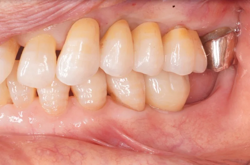 見た目としっかり噛める機能を両立した治療