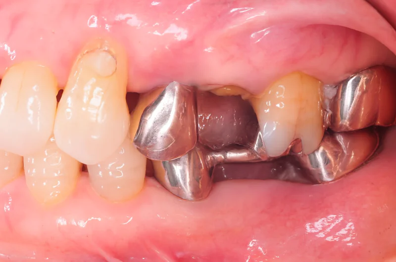 見た目としっかり噛める機能を両立した治療