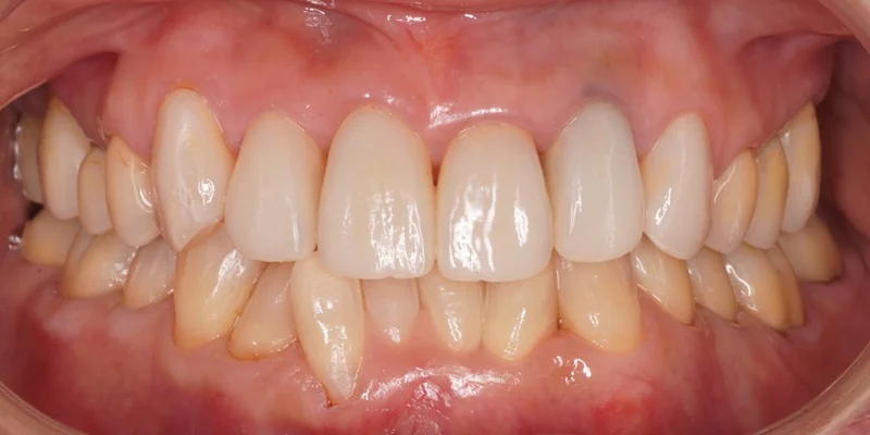 削る量を最小限に抑えたE.maxクラウン・ベニアによる全顎審美治療