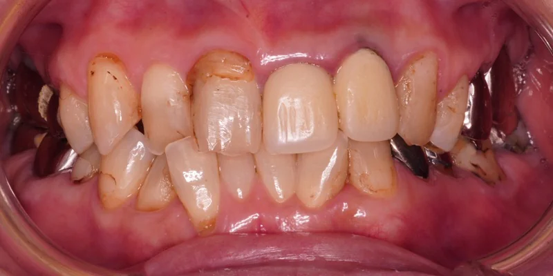 削る量を最小限に抑えたE.maxクラウン・ベニアによる全顎審美治療