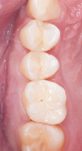 強化型セラミックによる低侵襲な虫歯治療（E.maxインレー・オンレー）