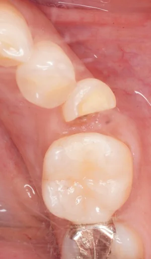 Emaxオンレー（下顎小臼歯）