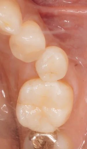 Emaxオンレー（下顎小臼歯）