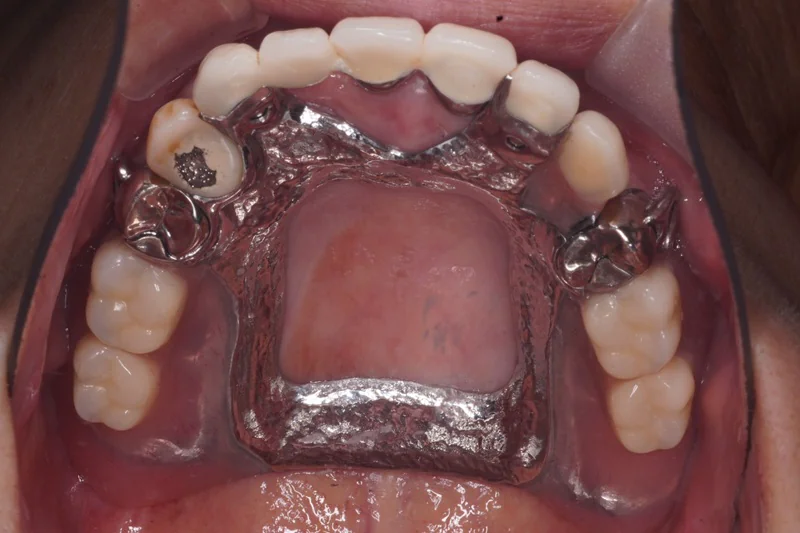 上顎部分床義歯（見た目と快適性を両立した設計）