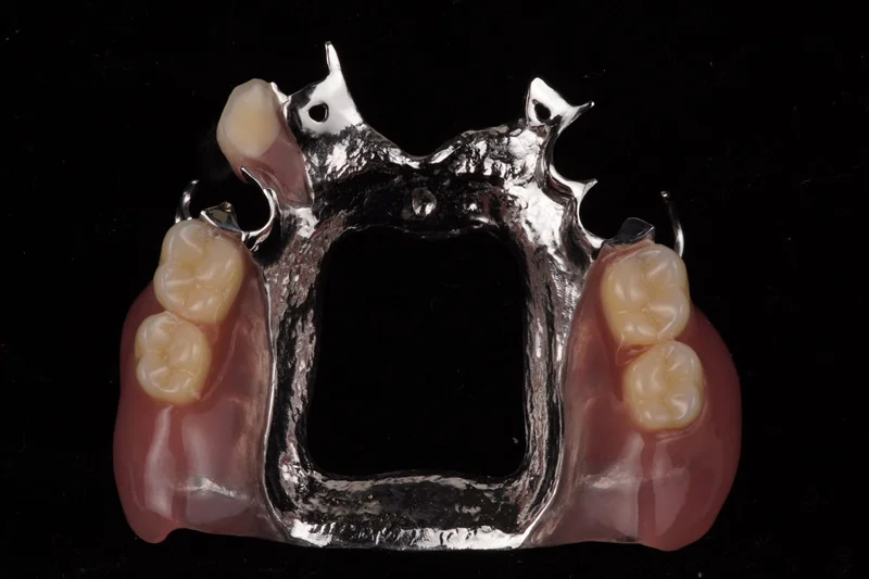 上顎部分床義歯（見た目と快適性を両立した設計）