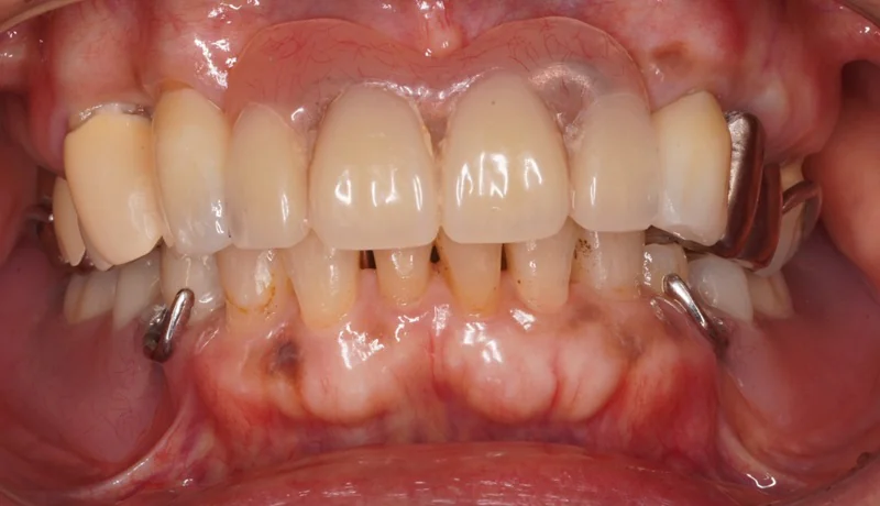 部分床義歯（部分入れ歯）