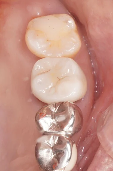 ジルコニアクラウンによる治療（1本）