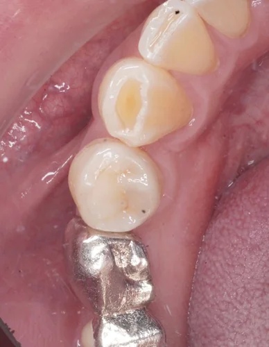 銀歯が外れた後の再治療：Emaxセラミック・オンレーで歯を守る