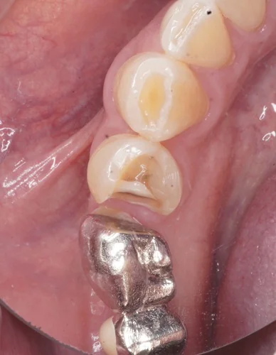 銀歯が外れた後の再治療：Emaxセラミック・オンレーで歯を守る