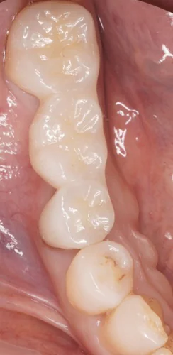 強度と審美性を兼ね備えたジルコニアブリッジによる再治療