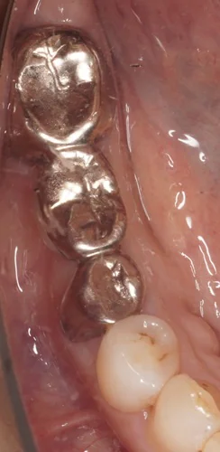 強度と審美性を兼ね備えたジルコニアブリッジによる再治療