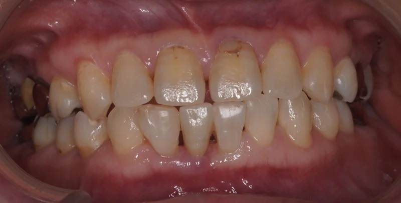 ジルコニア接着性ブリッジによる低侵襲の欠損補綴治療