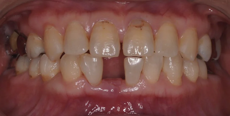 ジルコニア接着性ブリッジによる低侵襲の欠損補綴治療