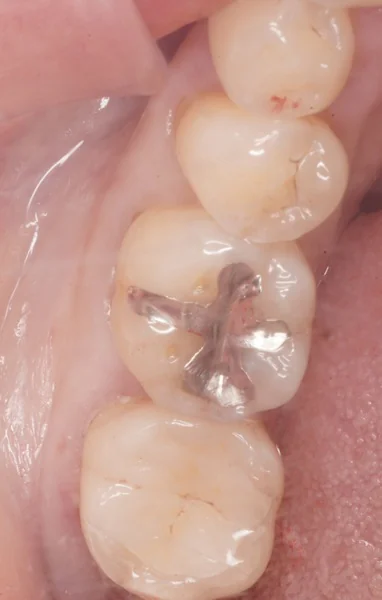 繰り返す虫歯への対処：E.maxオンレーでの再治療と生活習慣の見直し