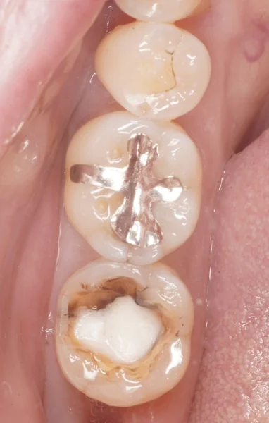 繰り返す虫歯への対処：E.maxオンレーでの再治療と生活習慣の見直し