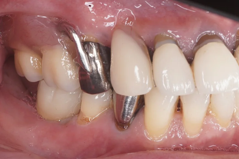 下顎臼歯部インプラント＋上顎部分床義歯の症例紹介