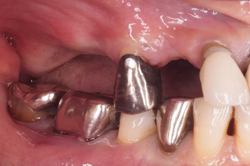 下顎臼歯部インプラント＋上顎部分床義歯の症例紹介